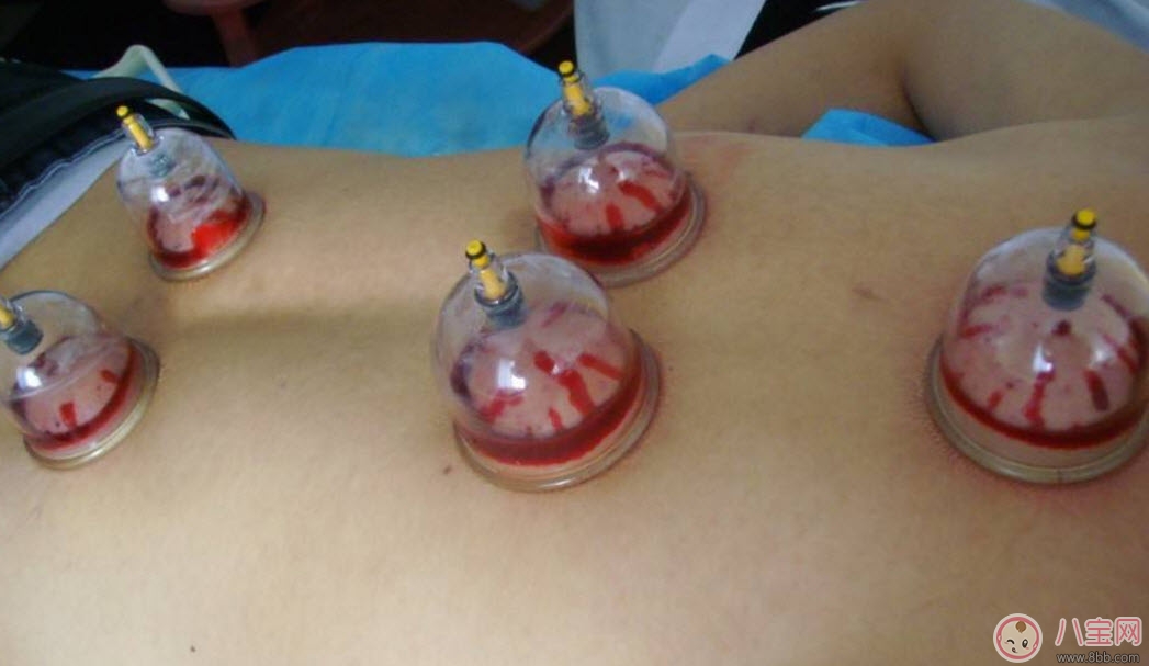 健康|孕妇拔火罐可以吗 孕妇肩膀能拔火罐吗(孕妇拔过火罐怎么办)