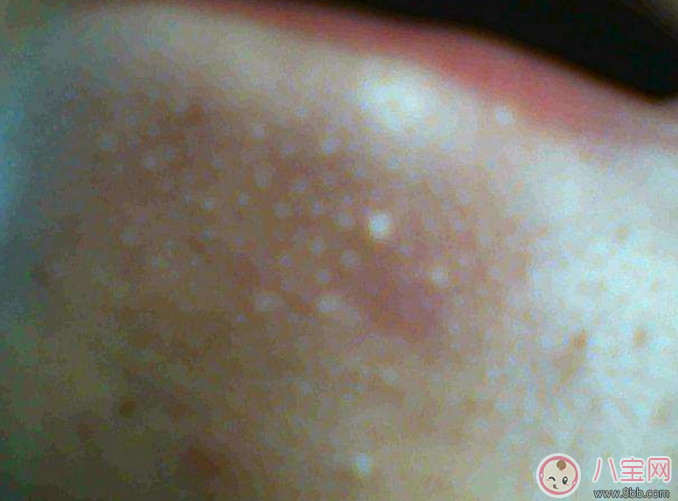 黑头|抿嘴时下巴上面的白色小颗粒是不是粉刺