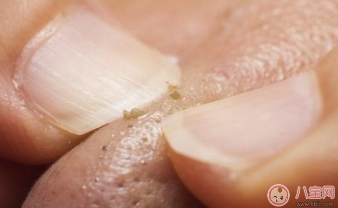 黑头|抿嘴时下巴上面的白色小颗粒是不是粉刺