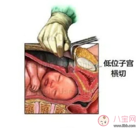 孕妇|剖腹产孕妇会不会感到疼痛 剖腹产横剖还是纵剖。
