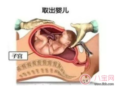 孕妇|剖腹产孕妇会不会感到疼痛 剖腹产横剖还是纵剖。