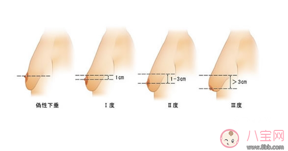 丰胸|妈妈断奶后如何丰胸 胸部下垂拯救办法