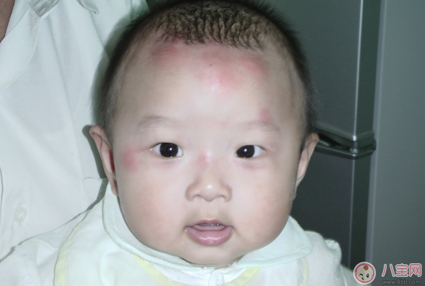 蚊子|孩子用花露水竟然出现状况 驱蚊给孩子用什么好
