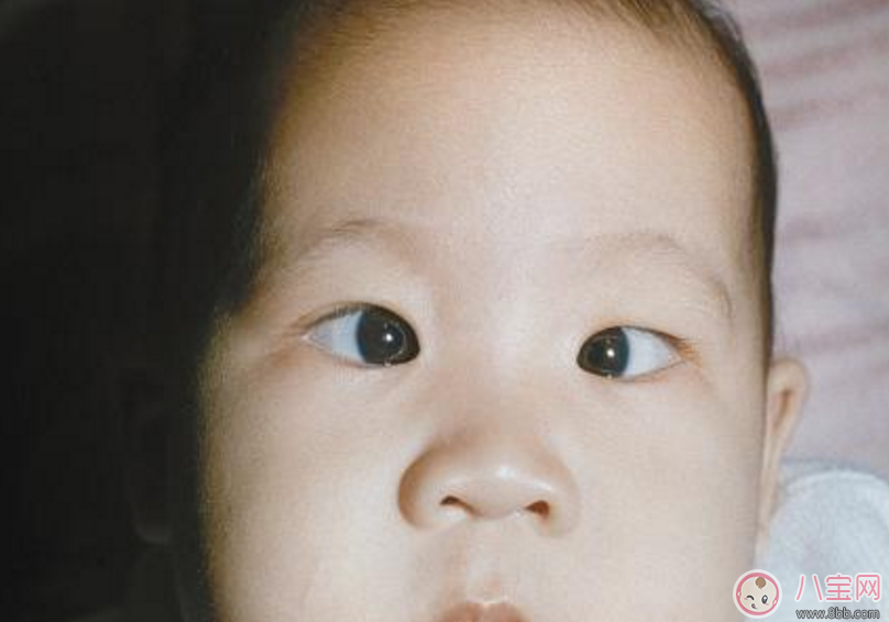 豆豆眼|孩子内斜视怎么办 怎么纠正孩子内斜视