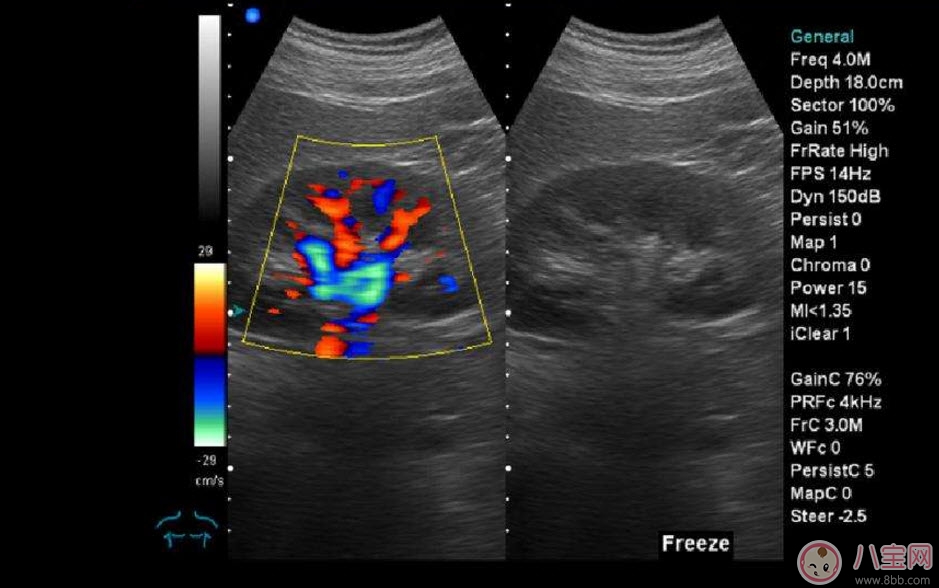 彩超|b超和彩超的区别 什么情况下使用普通B超或彩超