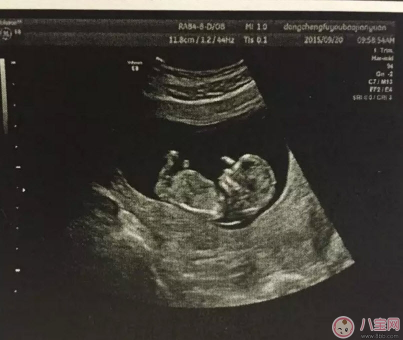 彩超|b超和彩超的区别 什么情况下使用普通B超或彩超