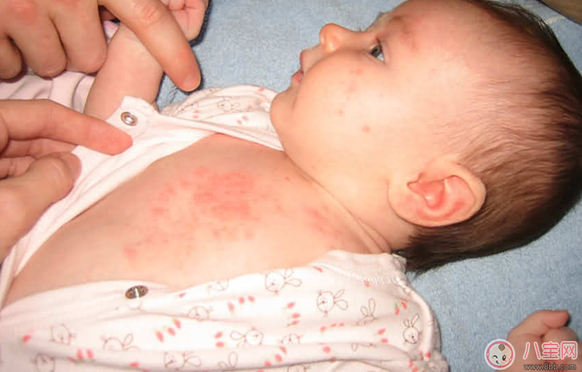 痱子|宝宝痱子总不消 用用这个准会好