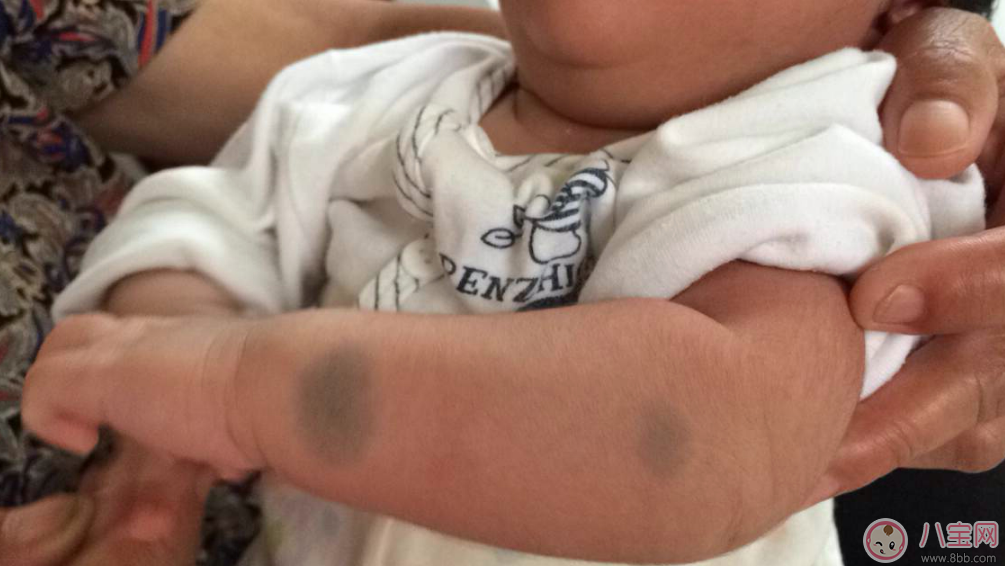 胎记|宝宝胎记会自己掉吗 宝宝胎记去除方法