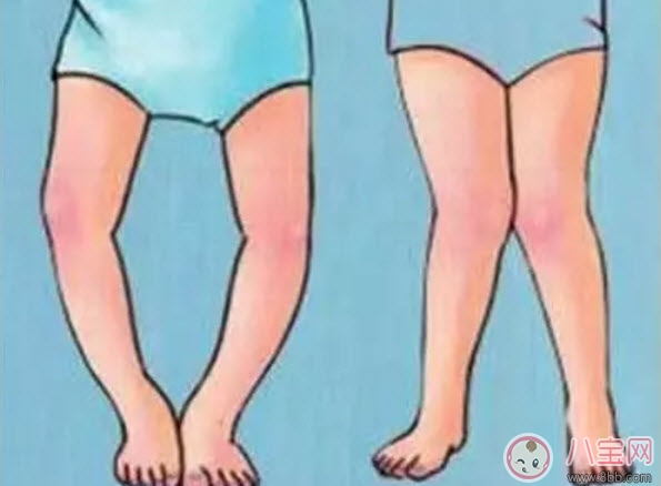 佝偻病|小儿佝偻病的症状 小儿佝偻病的预防治疗