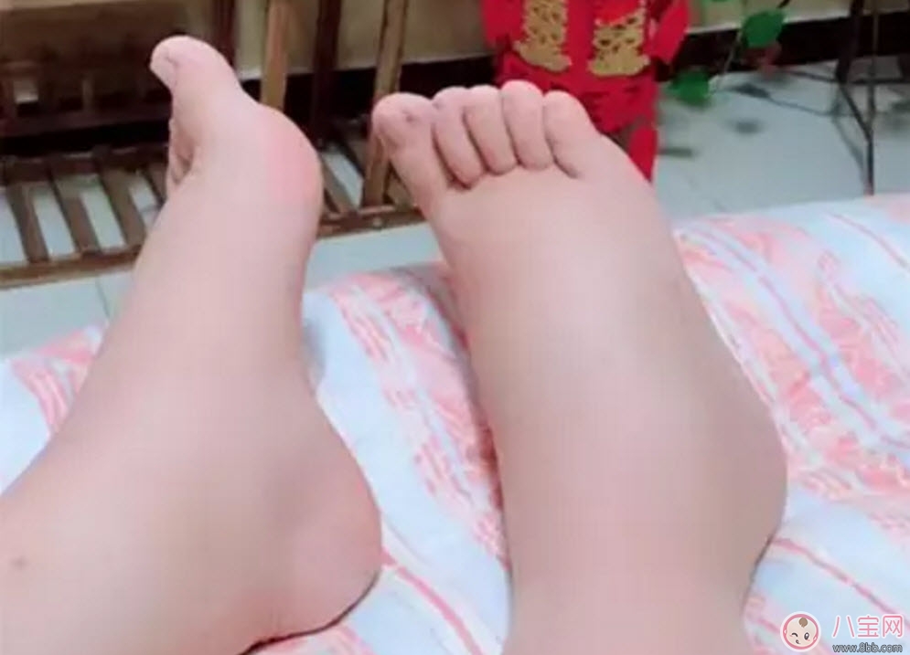 水肿|孕晚期水肿怎么缓解 孕妇孕晚期浮肿是什么原因