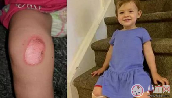 烫伤|这样居然也能烫伤 三伏天户外儿童玩具少让孩子玩