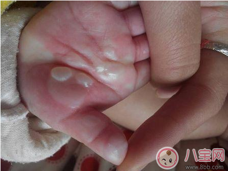 烫伤|孩子烫伤后抹酱油有效吗 这些偏方烫伤后千万不要学