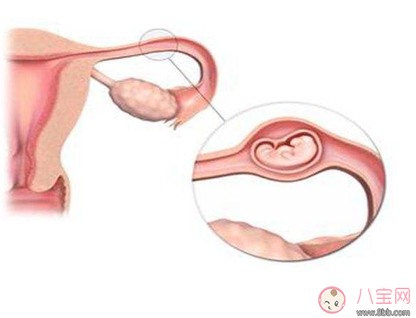 怀孕|导致宫外孕危害相当大 生活中这样做可以预防