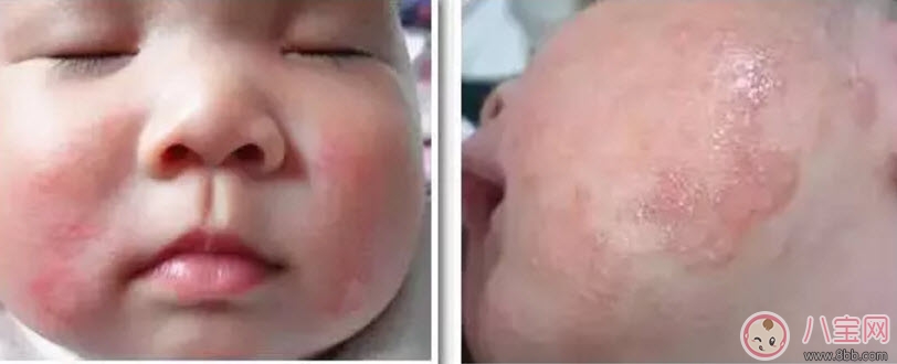 湿疹|宝宝痱子和湿疹的区别 宝宝湿疹和痱子最大的不同是什么