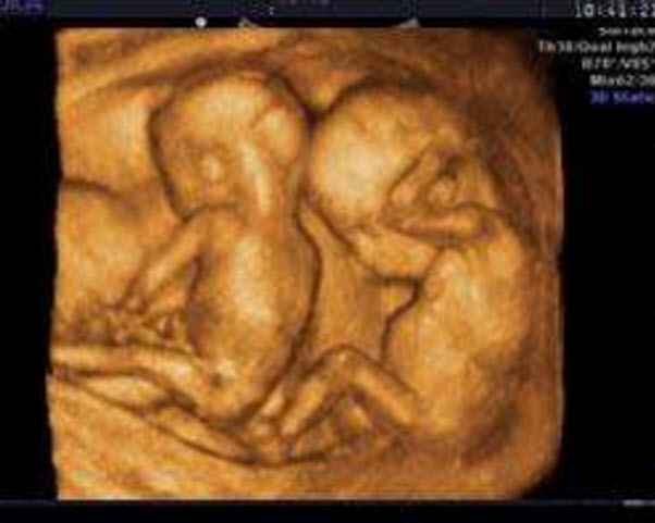 双胞胎|孕妇怀双胞胎吃什么好 孕妇怀双胞胎的症状有哪些