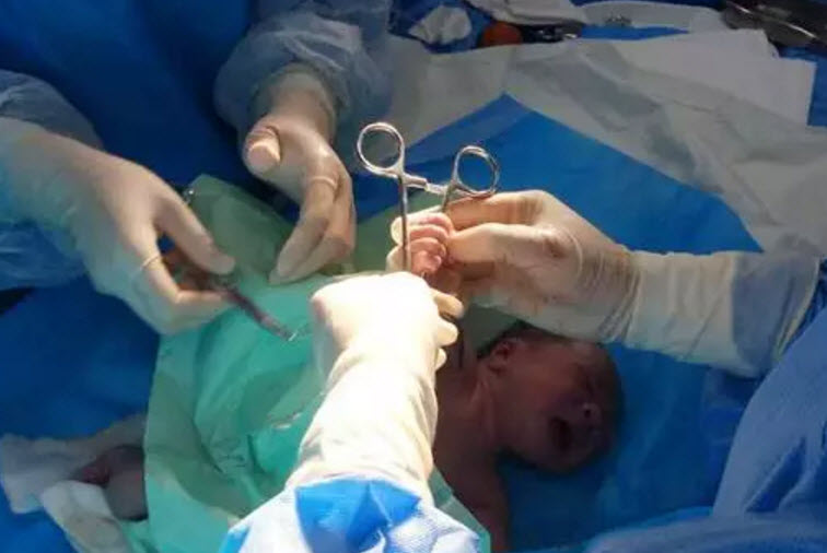 宝宝|剪脐带时宝宝会不会疼 剪脐带是宝宝疼还是妈妈疼