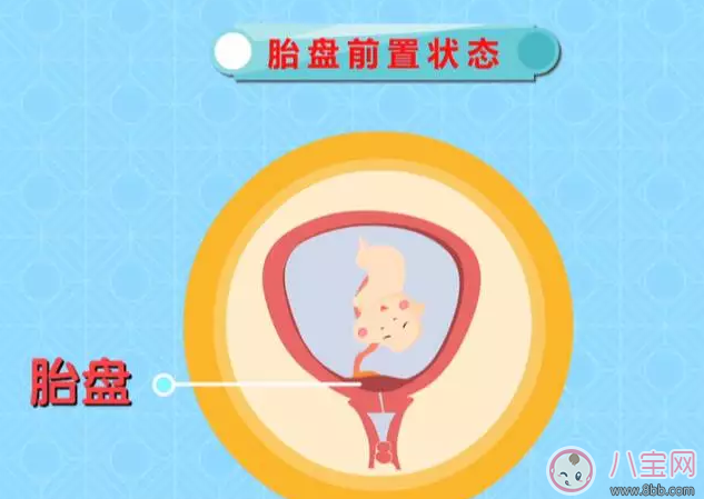 剖腹产|怀孕后那些情况不能顺产 有些时候多听医嘱准没错