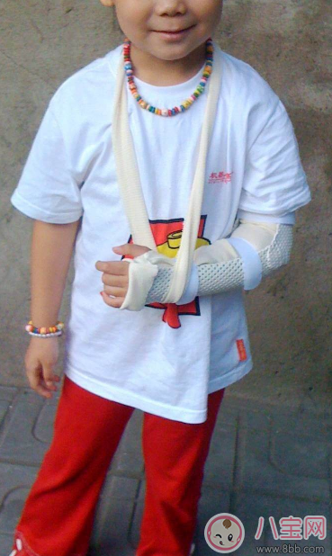 骨折|孩子总是容易骨折 孩子骨折后怎么处理