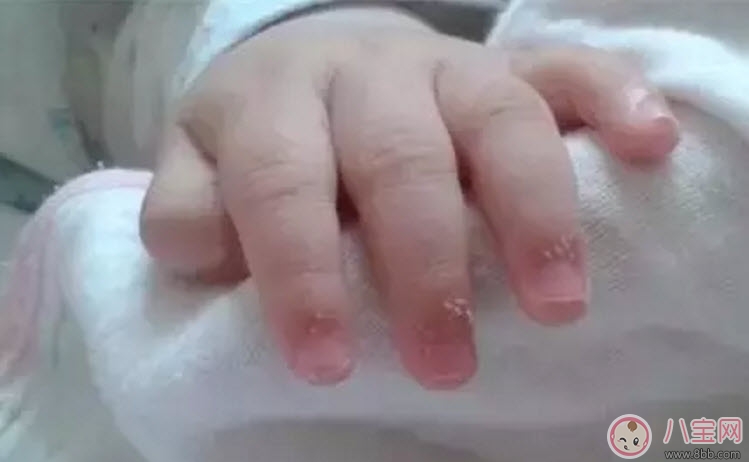 倒刺|宝宝手上长肉刺是因为缺乏营养吗 宝宝手指上长倒刺是什么原因