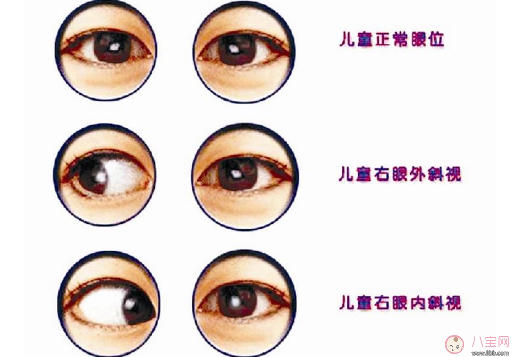 手术|宝宝斜视手术风险大吗 宝宝斜视一定要做手术吗