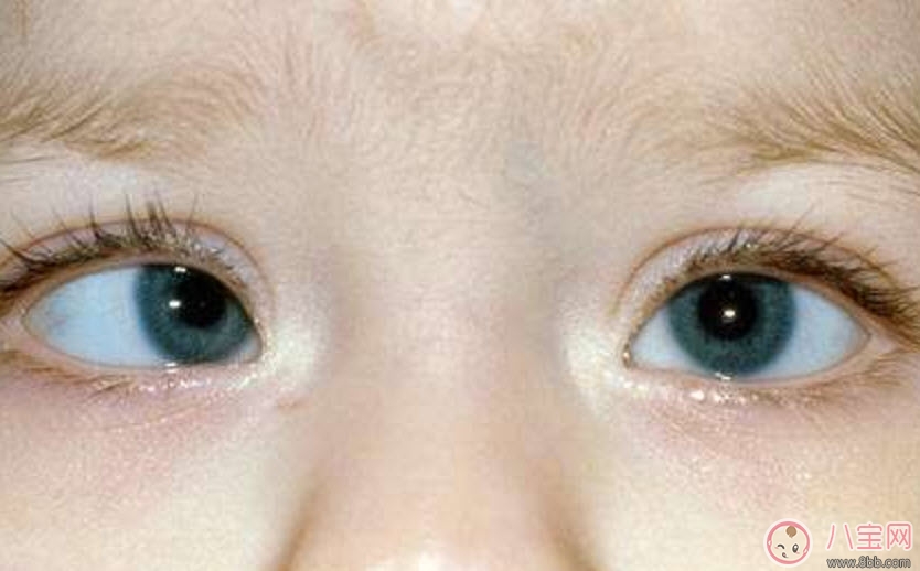 手术|宝宝斜视手术风险大吗 宝宝斜视一定要做手术吗