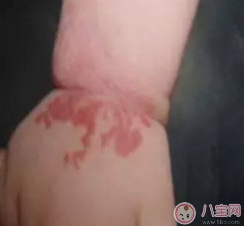 胎记|新生儿红色胎记和血管瘤的对比方法 宝宝胎记和血管瘤的区别