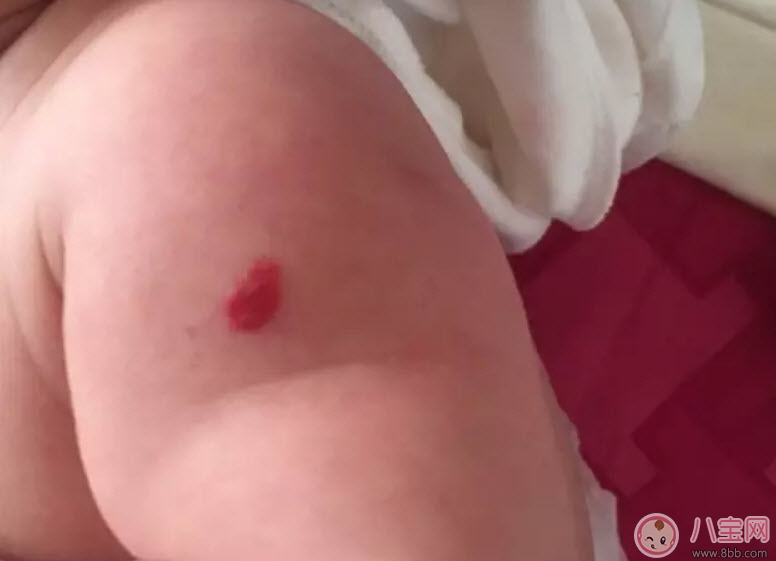 胎记|新生儿红色胎记和血管瘤的对比方法 宝宝胎记和血管瘤的区别