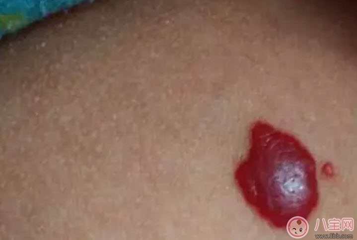胎记|新生儿红色胎记和血管瘤的对比方法 宝宝胎记和血管瘤的区别