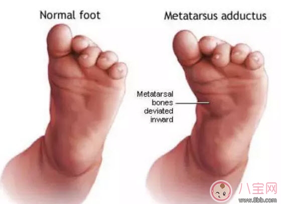 健康|宝宝走路内八字怎么办 宝宝走路内八字的原因有哪些