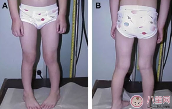 健康|宝宝走路内八字怎么办 宝宝走路内八字的原因有哪些