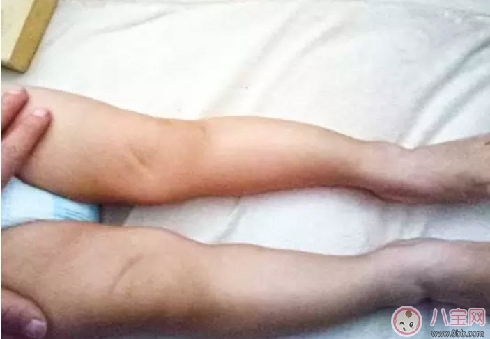 腿|婴儿为什么是青蛙腿 宝宝青蛙腿用不用绑腿