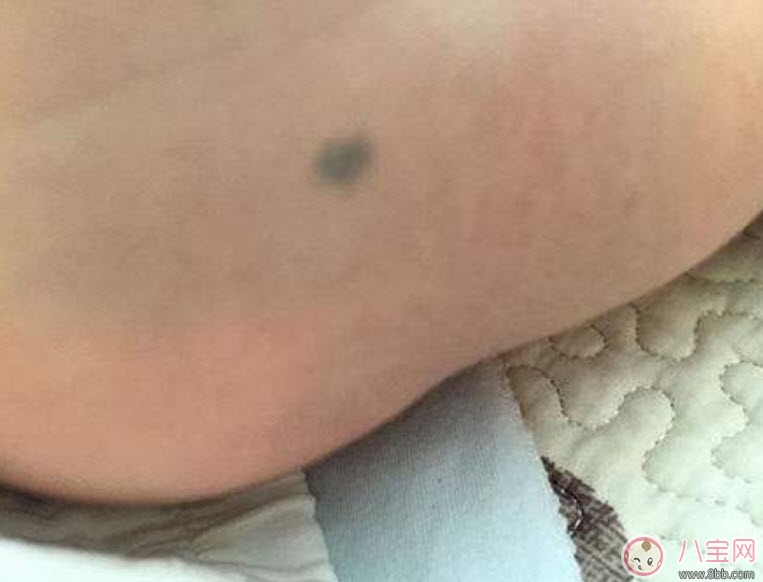 宝宝|婴儿屁股下面有胎记有什么含义 新生儿宝宝屁股下面有胎记好不好