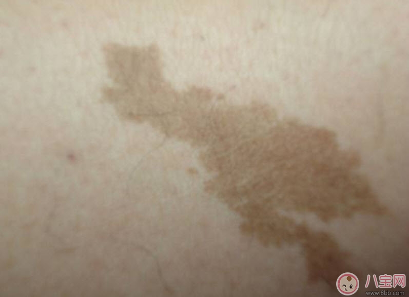 宝宝|婴儿屁股下面有胎记有什么含义 新生儿宝宝屁股下面有胎记好不好