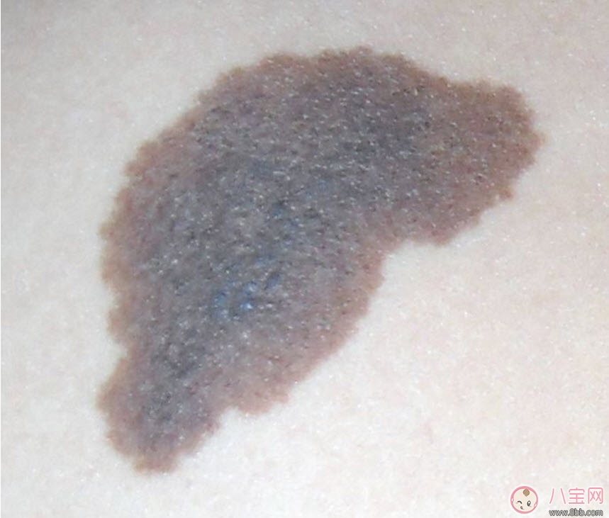 宝宝|婴儿屁股下面有胎记有什么含义 新生儿宝宝屁股下面有胎记好不好