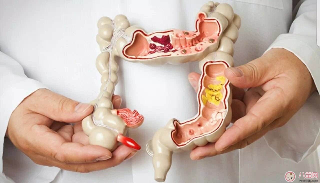 症状|大肠癌常见症状 如何预防大肠癌