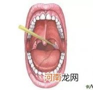 孩子扁桃体总发炎该不该切除？