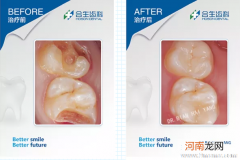 补牙为何不能一次完成？