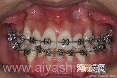 矫正牙齿几岁最适宜？