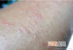 中西医治疗湿疹各有妙招