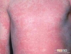 孩子发热伴皮疹当心猩红热