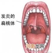 孩子扁桃体要不要“下岗”？