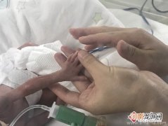 图 早产＂袖珍婴儿＂重约一瓶水