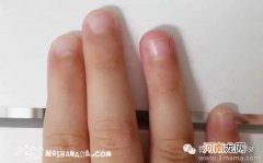 儿童咬指甲要及早纠正