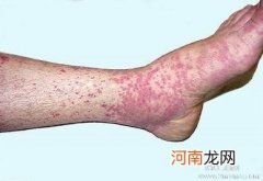 中医对紫癜的独道治疗法