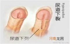 尿道下裂手术最好两岁前做
