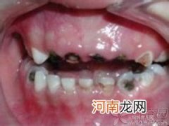 如何保护乳牙不龋齿呢