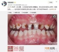 让孩子牙齿整齐的秘籍
