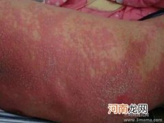 春季小儿要防“三疹”