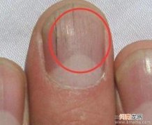 从指甲纹理看孩子的健康