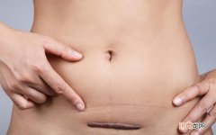 剖宫产后多久适合怀孕 剖腹产后多久可以生二胎